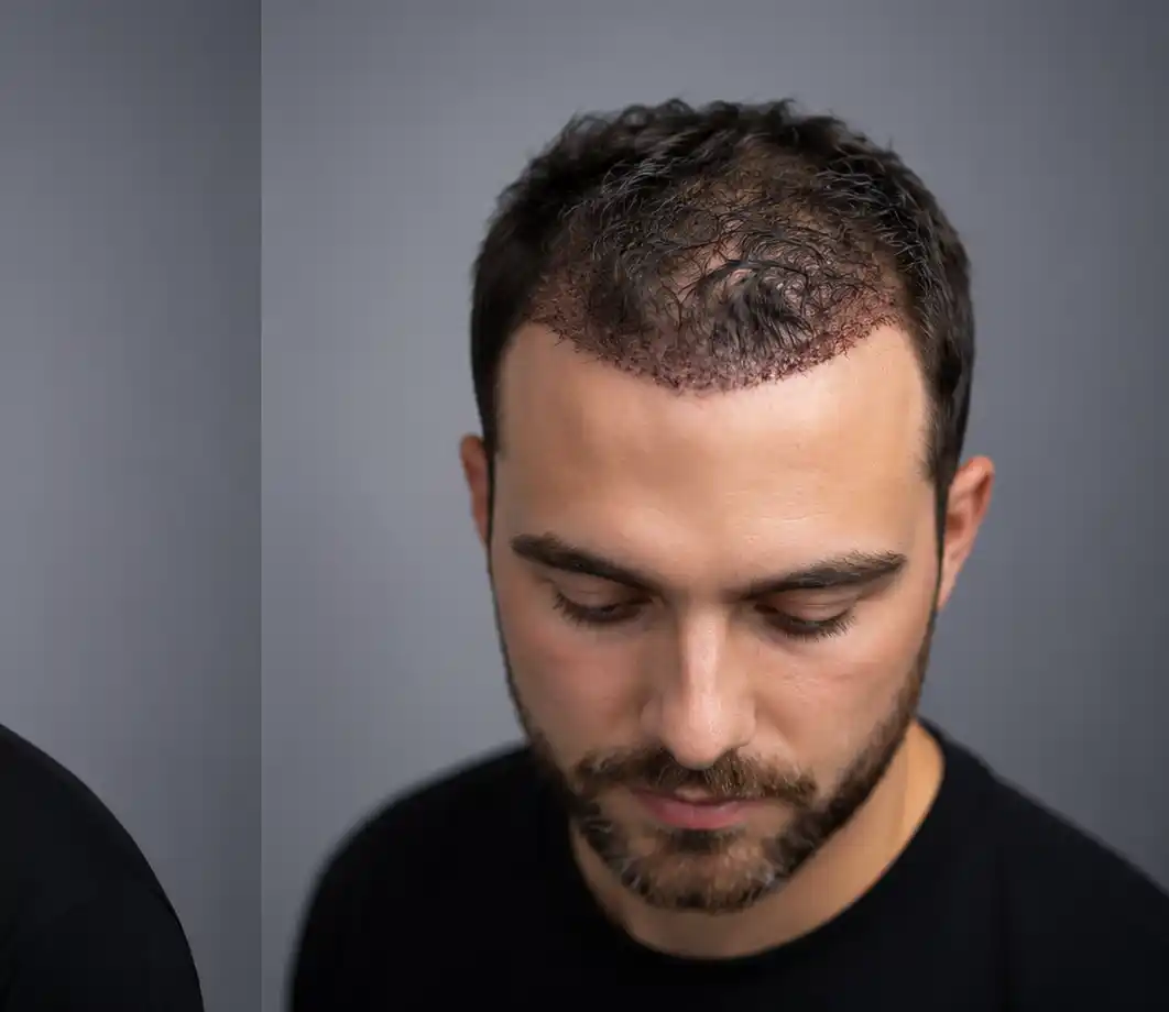Unshaven Hair Transplant